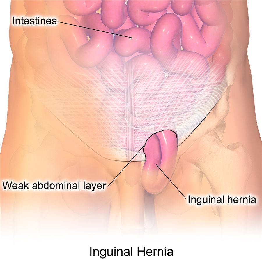 Diagrama de hernia inguinal